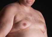 man boobs