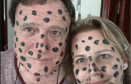 קרוב המשפחה המפורסם מצטרף בפוסט הזדהות עם הילד עם נקודות החן הגדולות