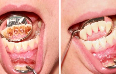 למה אסור לך לוותר על טיפול שיננית