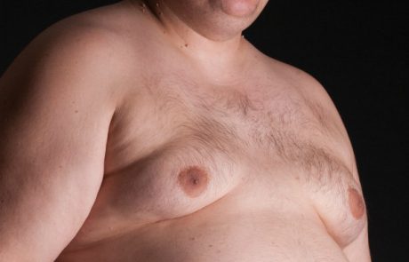 יש פיתרון ל-Man Boobs